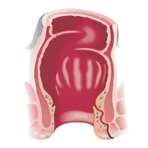 Cirujano Gastrointestinal en Morelia