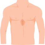 Cirugía de Hernia en Morelia