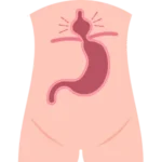 Cirugía de Hernia en Morelia