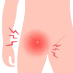 Cirugía de Hernia en Morelia