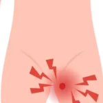 Cirugía de Hernia en Morelia