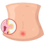 Cirugía de Hernia en Morelia