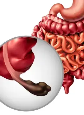 apendicitis Apendicetomía en Morelia